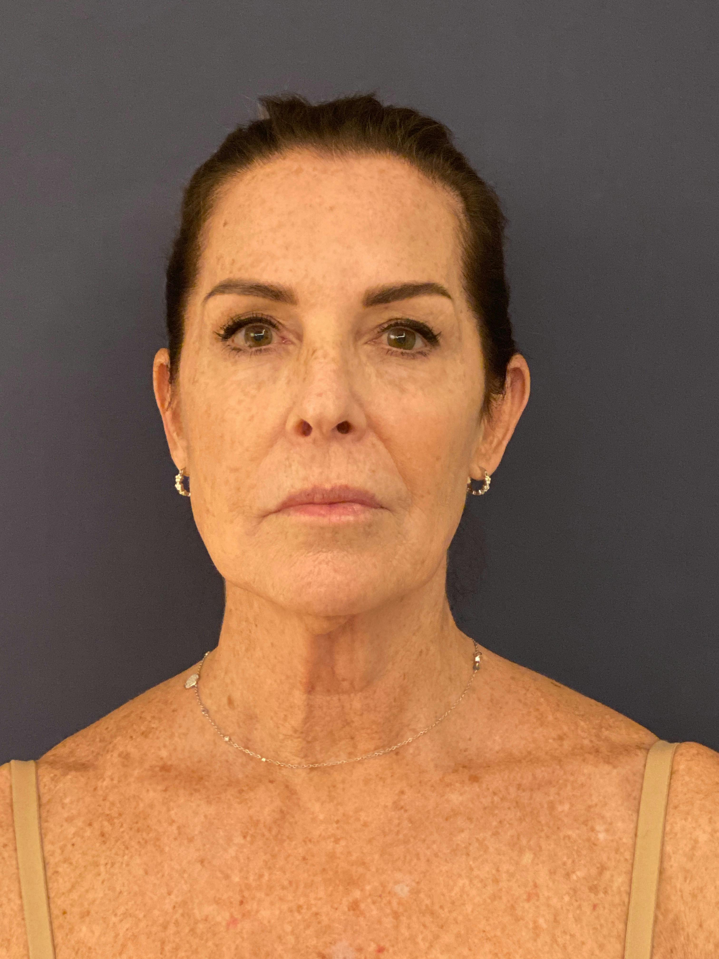 Facelift Before & After Gallery - Patient 174003314 - Image 1