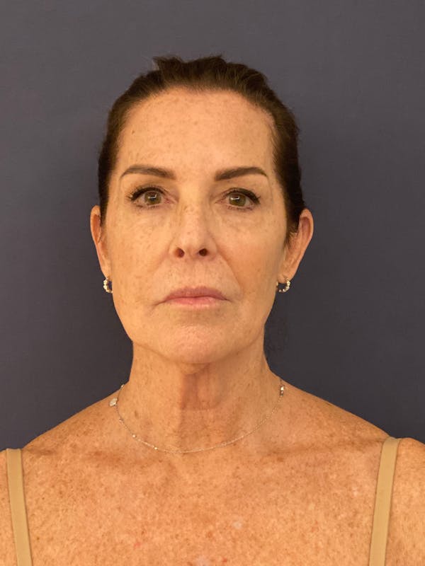 Neck Lift