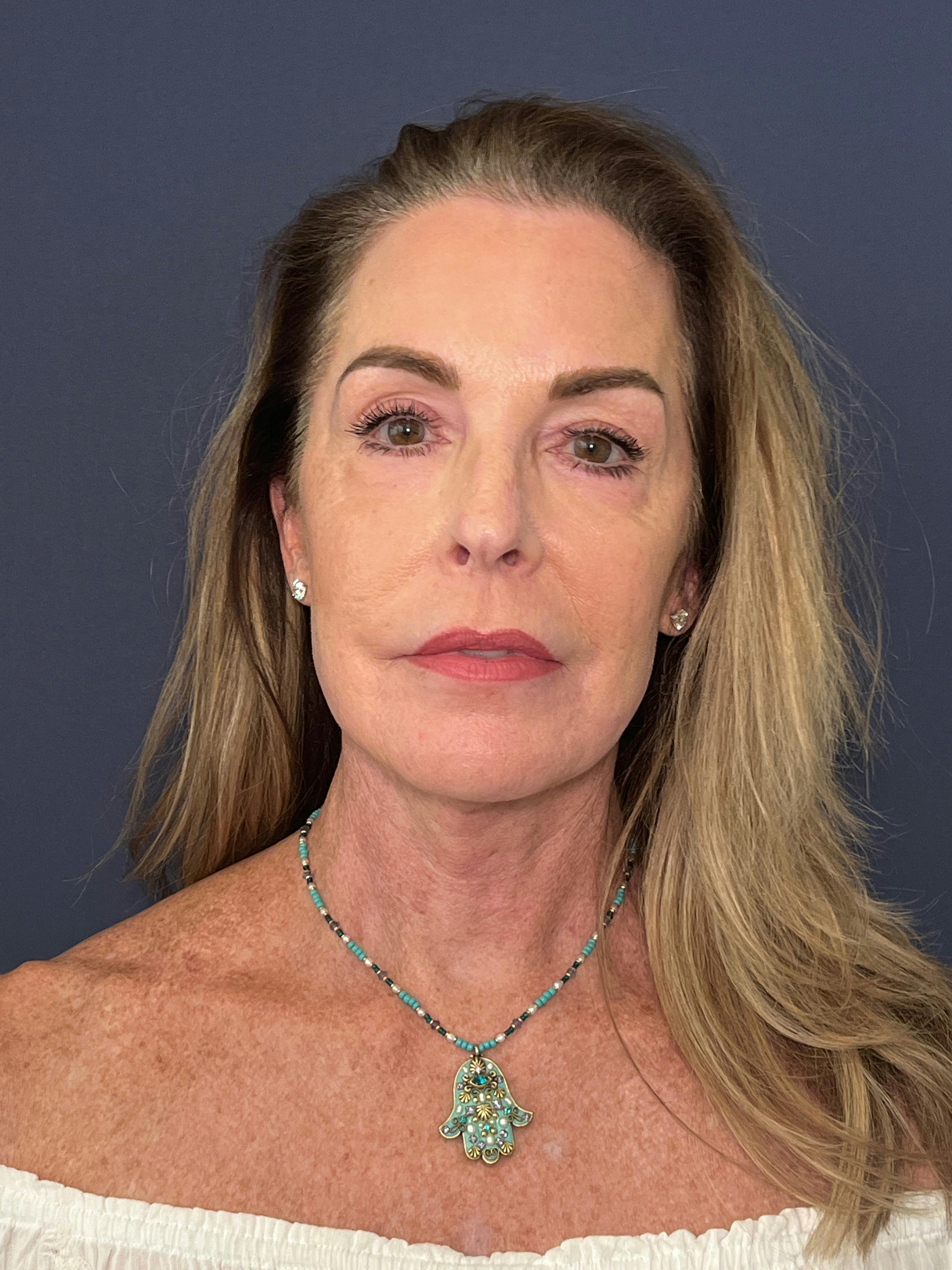 Facelift Before & After Gallery - Patient 174003314 - Image 2
