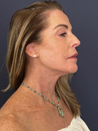 Facelift Before & After Gallery - Patient 174003314 - Image 4