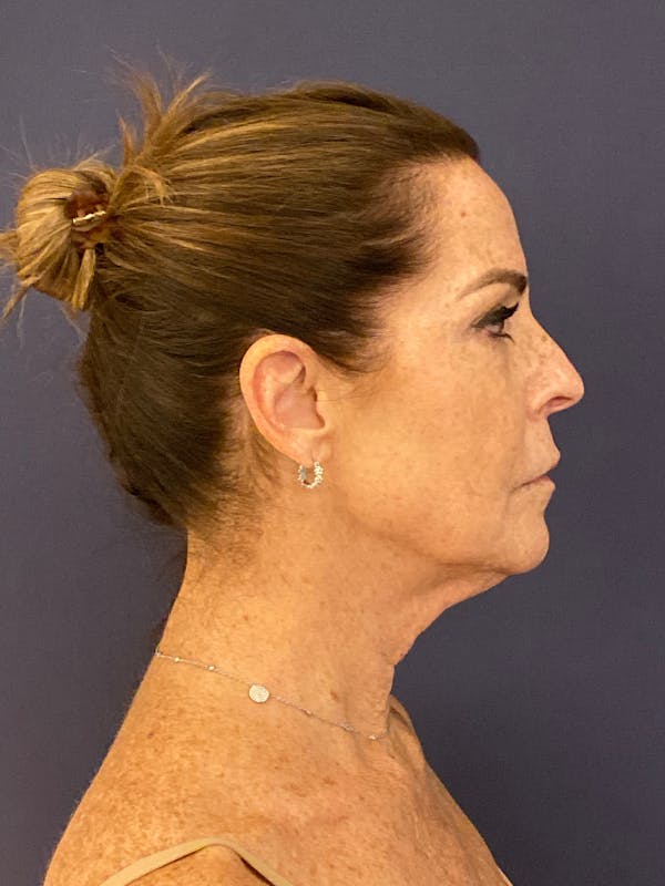 Facelift Before & After Gallery - Patient 174003314 - Image 3