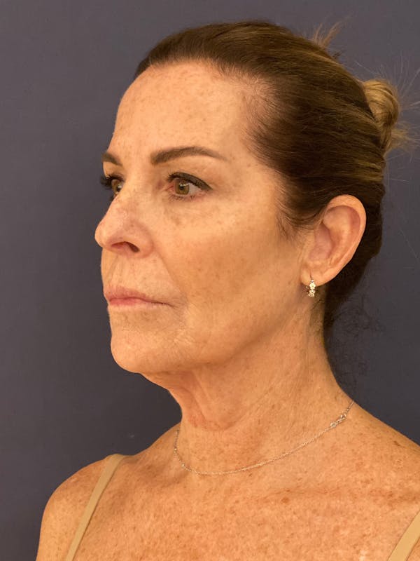 Facelift Before & After Gallery - Patient 174003314 - Image 5