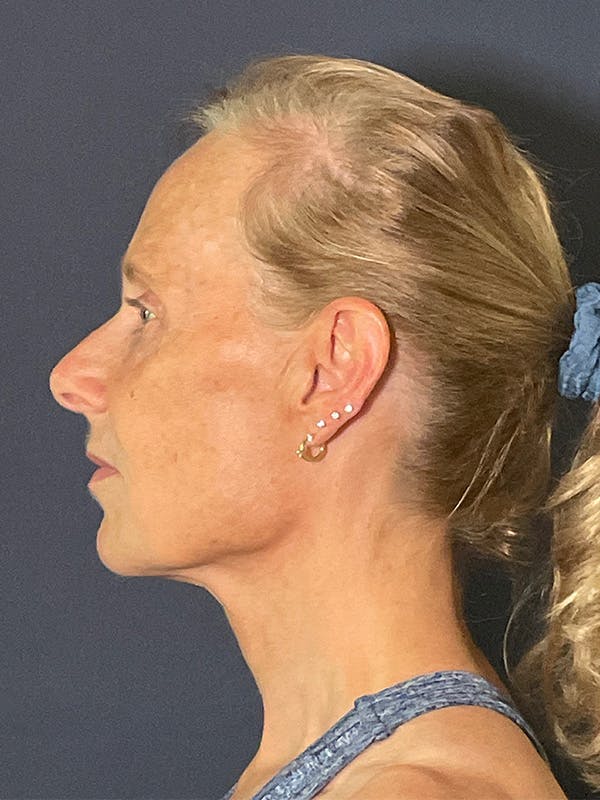 Facelift Before & After Gallery - Patient 355662 - Image 5