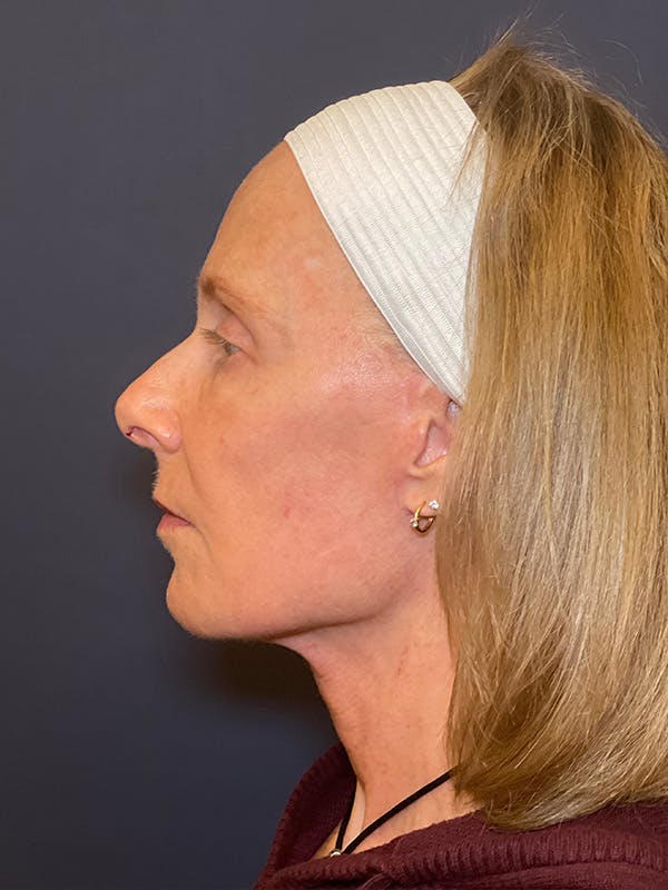Facelift Before & After Gallery - Patient 355662 - Image 6