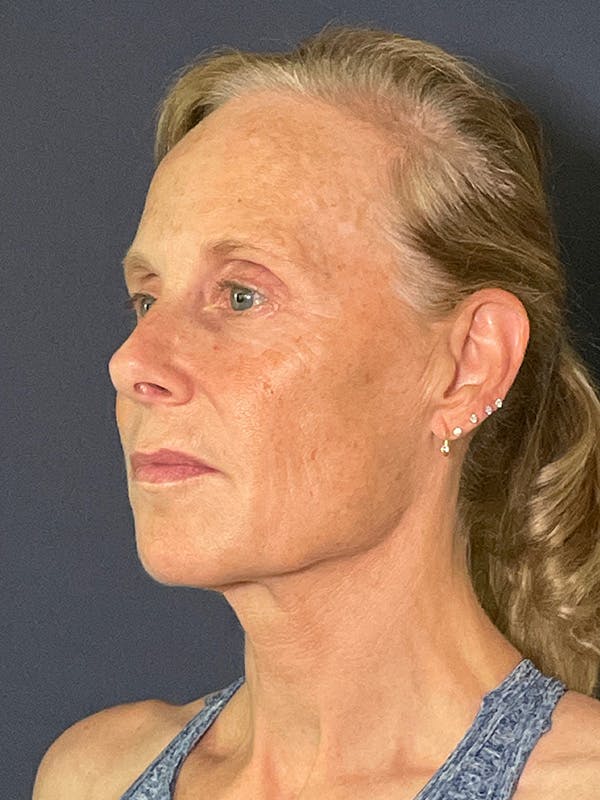 Facelift Before & After Gallery - Patient 355662 - Image 3