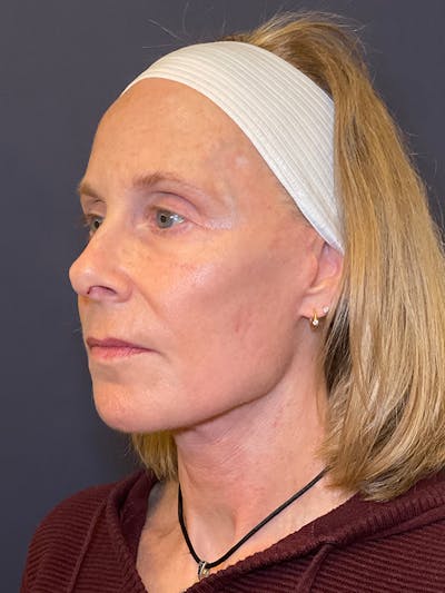 Facelift Before & After Gallery - Patient 355662 - Image 4