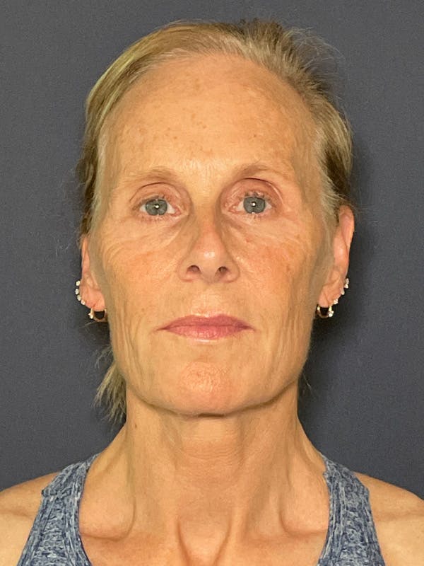 Facelift