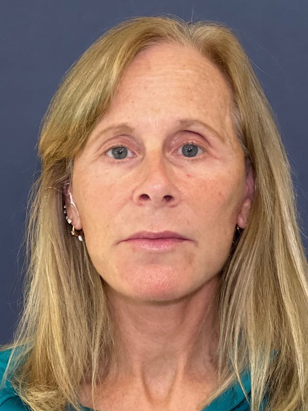 Facelift