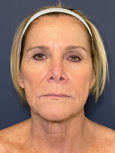 Facelift Before & After Gallery - Patient 138164 - Image 1