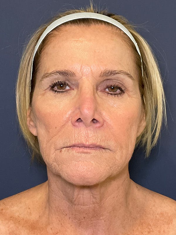 Facelift