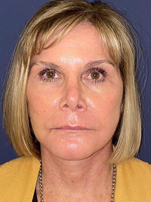 Facelift