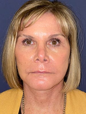 Neck Lift