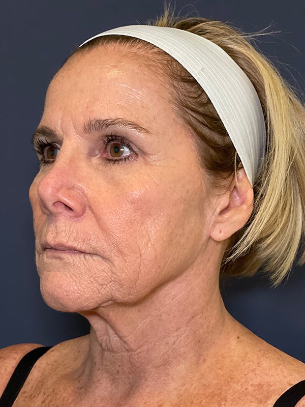 TRL Laser Before & After Gallery - Patient 189301 - Image 3