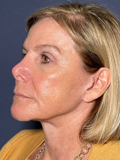 TRL Laser Before & After Gallery - Patient 189301 - Image 4