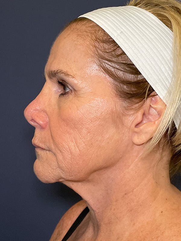 TRL Laser Before & After Gallery - Patient 189301 - Image 5