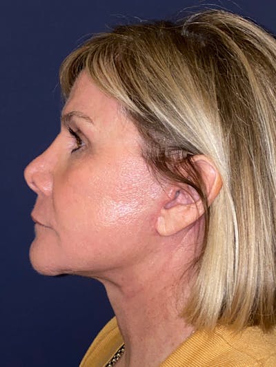 TRL Laser Before & After Gallery - Patient 189301 - Image 6