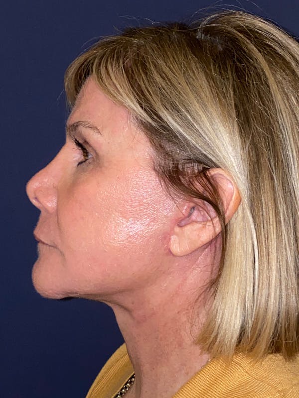 TRL Laser Before & After Gallery - Patient 189301 - Image 6
