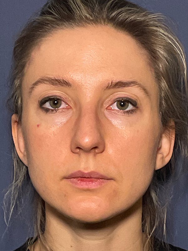 NaturaBrow® Before & After Gallery - Patient 581723 - Image 2