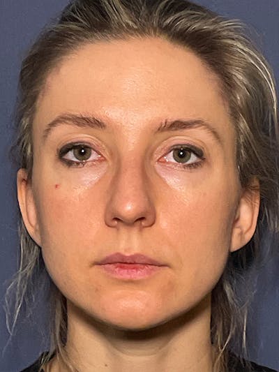 NaturaBrow® Before & After Gallery - Patient 581723 - Image 2