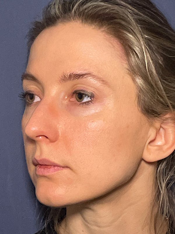 NaturaBrow® Before & After Gallery - Patient 581723 - Image 6