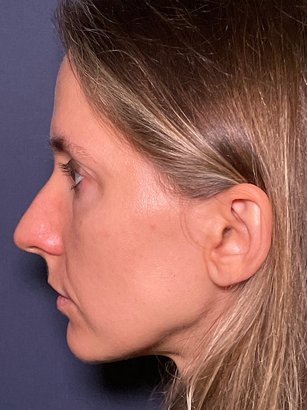 NaturaBrow® Before & After Gallery - Patient 581723 - Image 5