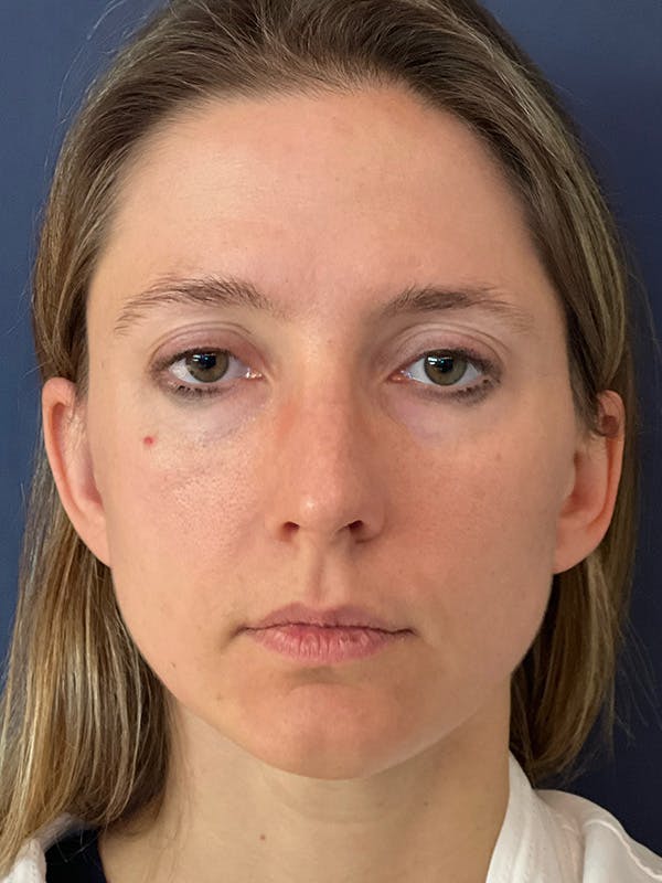 NaturaBrow® Before & After Gallery - Patient 581723 - Image 1