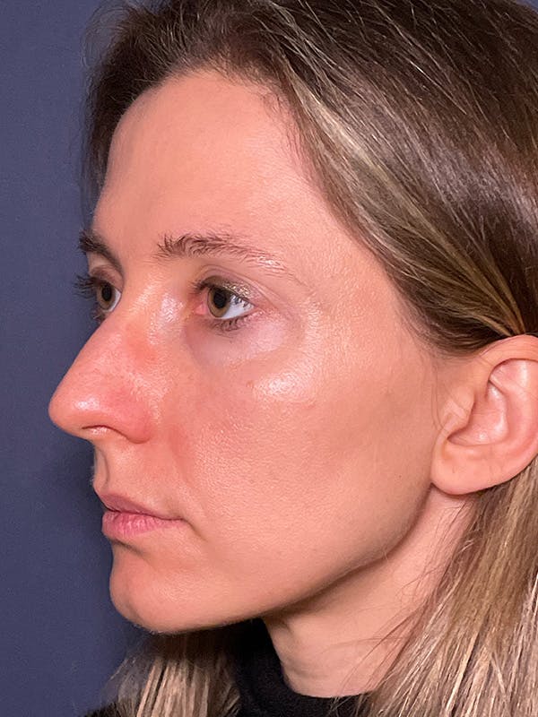 NaturaBrow® Before & After Gallery - Patient 581723 - Image 3