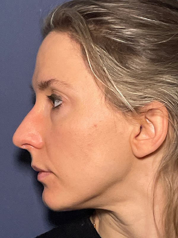 NaturaBrow® Before & After Gallery - Patient 581723 - Image 4