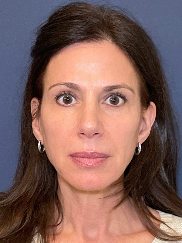NaturaBrow® Before & After Gallery - Patient 318820 - Image 2