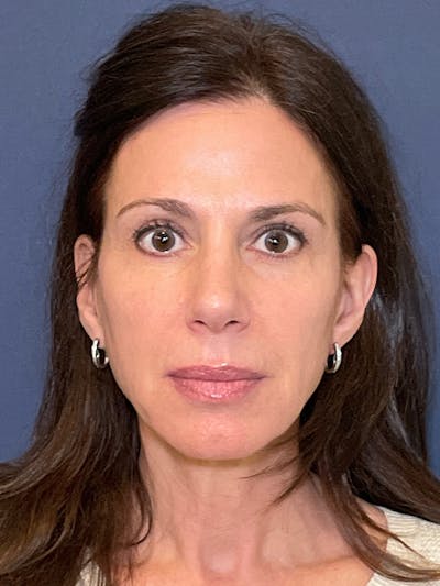 NaturaBrow® Before & After Gallery - Patient 318820 - Image 2