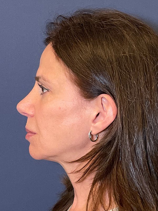 NaturaBrow® Before & After Gallery - Patient 318820 - Image 6
