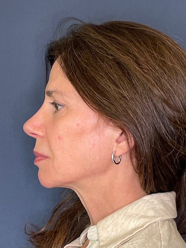 NaturaBrow® Before & After Gallery - Patient 318820 - Image 5