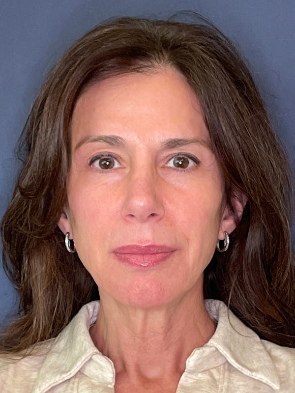 NaturaBrow® Before & After Gallery - Patient 318820 - Image 1
