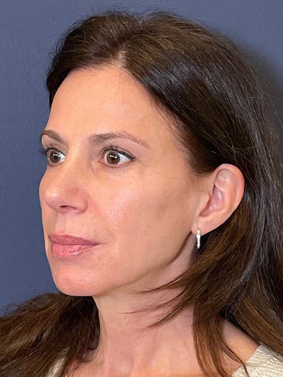 NaturaBrow® Before & After Gallery - Patient 318820 - Image 4
