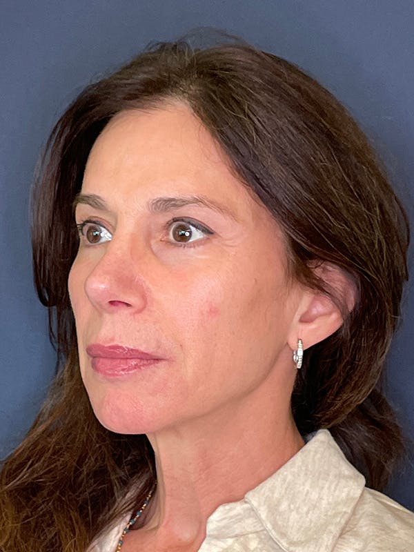 NaturaBrow® Before & After Gallery - Patient 318820 - Image 3
