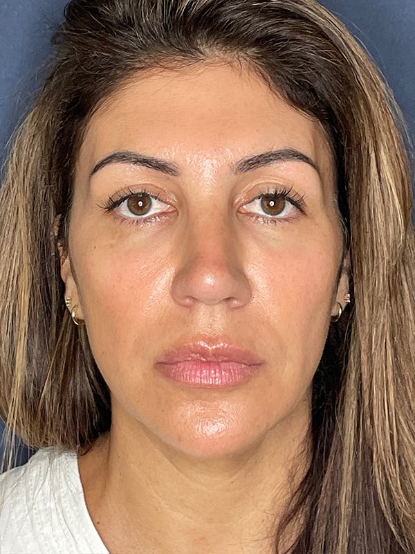 NaturaBrow® Before & After Gallery - Patient 386599 - Image 1