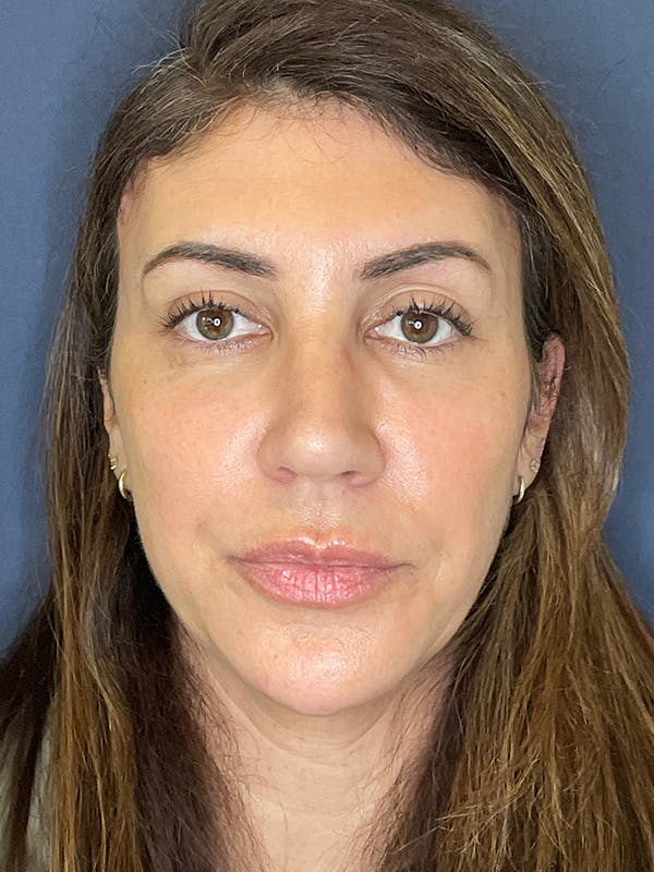 NaturaBrow® Before & After Gallery - Patient 386599 - Image 2