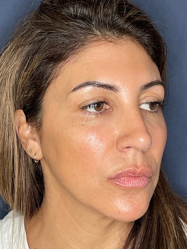 NaturaBrow® Before & After Gallery - Patient 386599 - Image 3