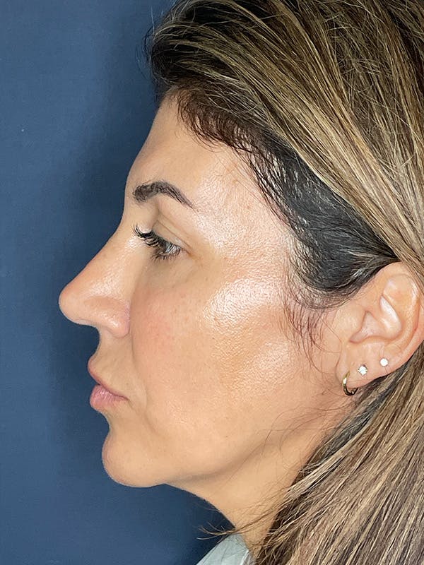 NaturaBrow® Before & After Gallery - Patient 386599 - Image 5