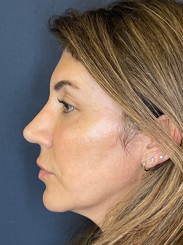 NaturaBrow® Before & After Gallery - Patient 386599 - Image 6