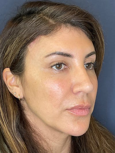 NaturaBrow® Before & After Gallery - Patient 386599 - Image 4