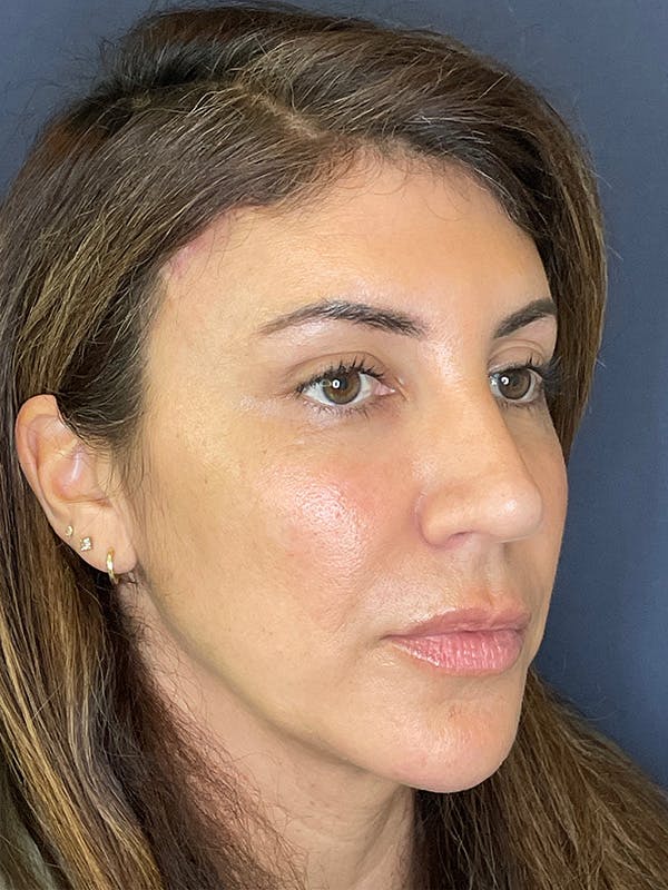 NaturaBrow® Before & After Gallery - Patient 386599 - Image 4
