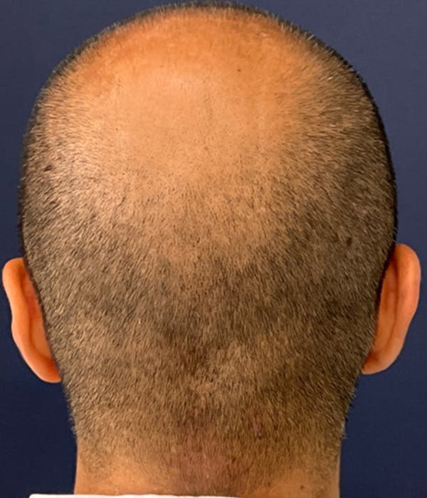 Neograft Before & After Gallery - Patient 251303 - Image 1