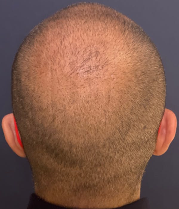 Neograft Before & After Gallery - Patient 251303 - Image 2