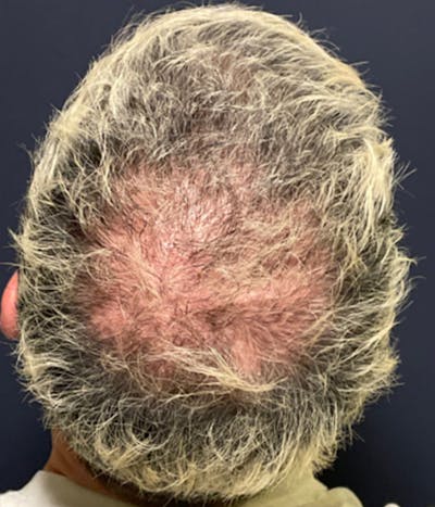 Neograft Before & After Gallery - Patient 155371 - Image 1