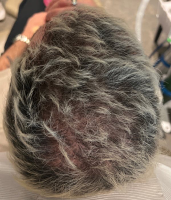 Neograft Before & After Gallery - Patient 155371 - Image 2