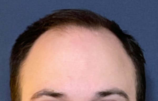 Neograft Before & After Gallery - Patient 240058 - Image 1