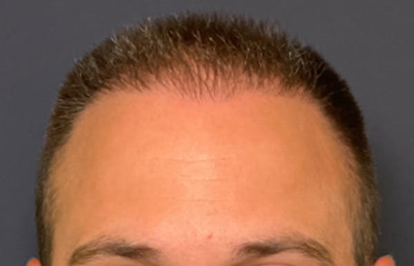 Neograft Before & After Gallery - Patient 240058 - Image 2