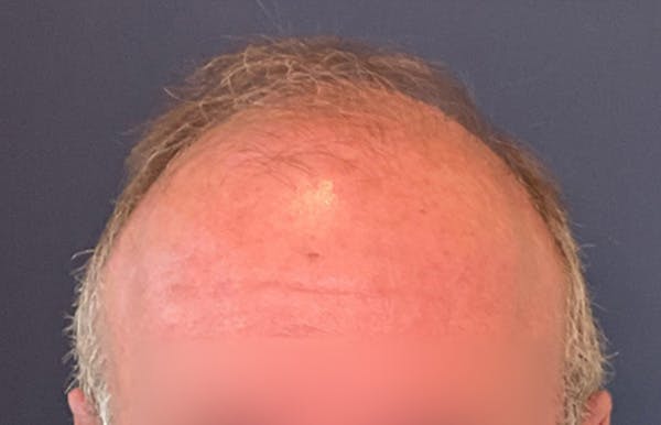 Neograft Before & After Gallery - Patient 111188 - Image 1