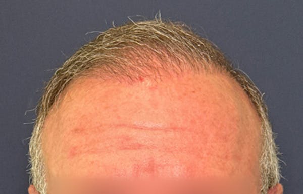 Neograft Before & After Gallery - Patient 111188 - Image 2